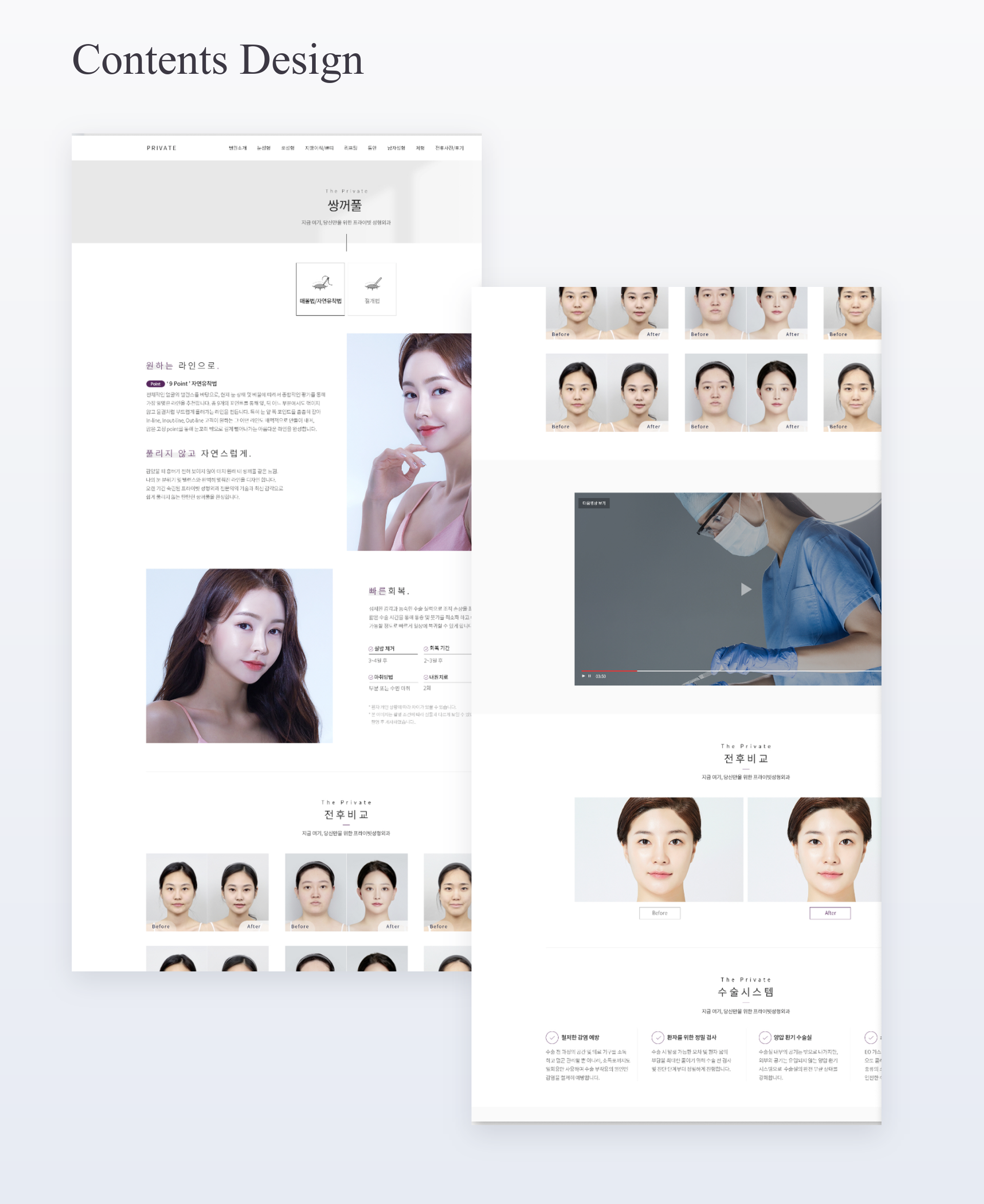 눈성형 상세페이지 시술 방식 설명과 전후 비교 콘텐츠 구성